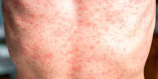 Paciente femenina de 24 años