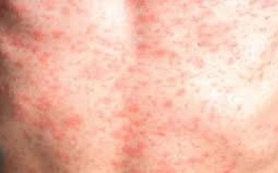 Paciente femenina de 24 años